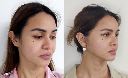 facelift & neck lift